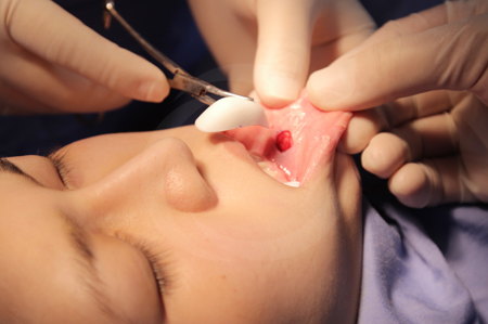 phau-thuat-tham-my-cam