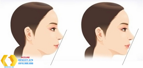 Tìm hiểu về phương pháp độn cằm có ảnh hưởng gì không?