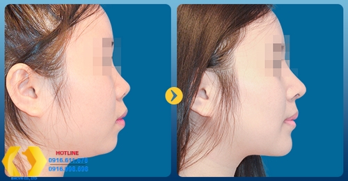 Tìm hiểu về phương pháp độn cằm có ảnh hưởng gì không?