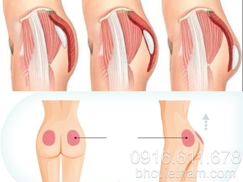 Ăn gì để mông to hơn hay phẫu thuật nâng mông?