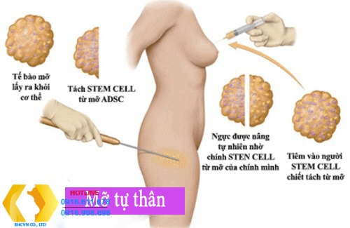 Các phương pháp nâng ngực phổ biến nhất hiện nay