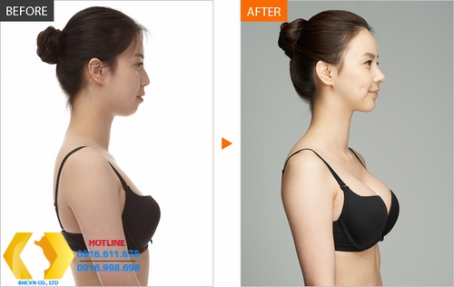 Các phương pháp nâng ngực phổ biến nhất hiện nay