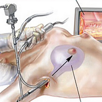 Nâng ngực nội soi qua đường nách