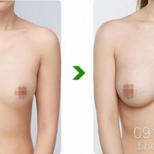 Giới thiệu cách làm ngực to không cần phẫu thuật
