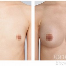 Hai công nghệ nâng ngực mới nhất hiện nay được các chị em tin tưởng lựa chọn