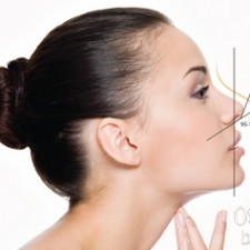 Sửa mũi bằng sụn tự thân có đặc điểm gì?