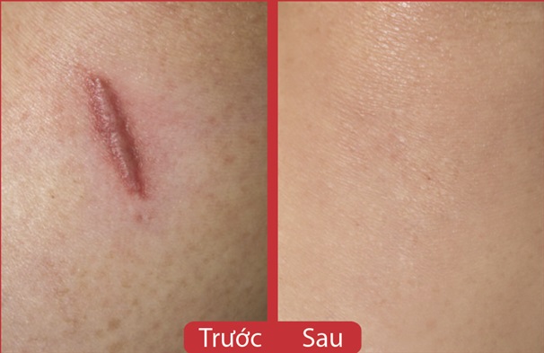 Scarguard 15ml: Kem trị sẹo lồi, sẹo phì đại hiệu quả nhanh nhất